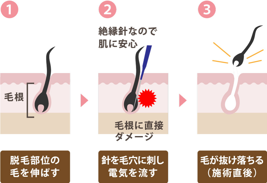 医療針脱毛（ニードル脱毛）｜大阪心斎橋のスキンクリニック亜門